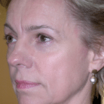 Face and Neck Before Procedure