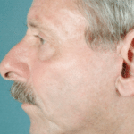 Face and Neck After Procedure