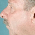 Face and Neck Before Procedure