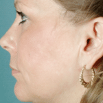 Face and Neck After Procedure