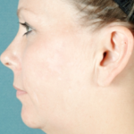 Face and Neck Before Procedure