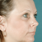 Face and Neck After Procedure