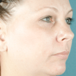 Face and Neck Before Procedure