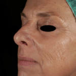 Fractional Laser Before Procedure