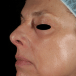 Fractional Laser After Procedure