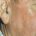 IPL After Procedure
