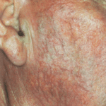 IPL Before Procedure