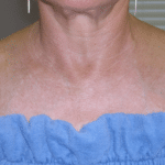 IPL After Procedure