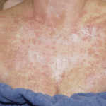 IPL Before Procedure