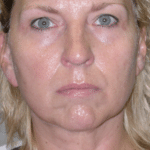 IPL After Procedure