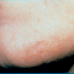 Laser Hair After Procedure