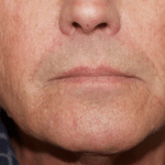 Radiesse After Procedure