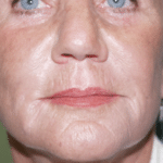 Radiesse After Procedure