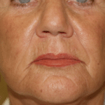 Radiesse Before Procedure
