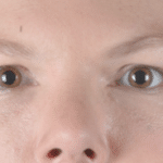 Restylane After Procedure