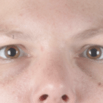 Restylane Before Procedure