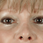 Restylane After Procedure