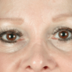 Restylane  Before Procedure