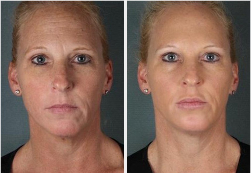 botox-fort-myers-dysport-bonita-springs-naples-fl