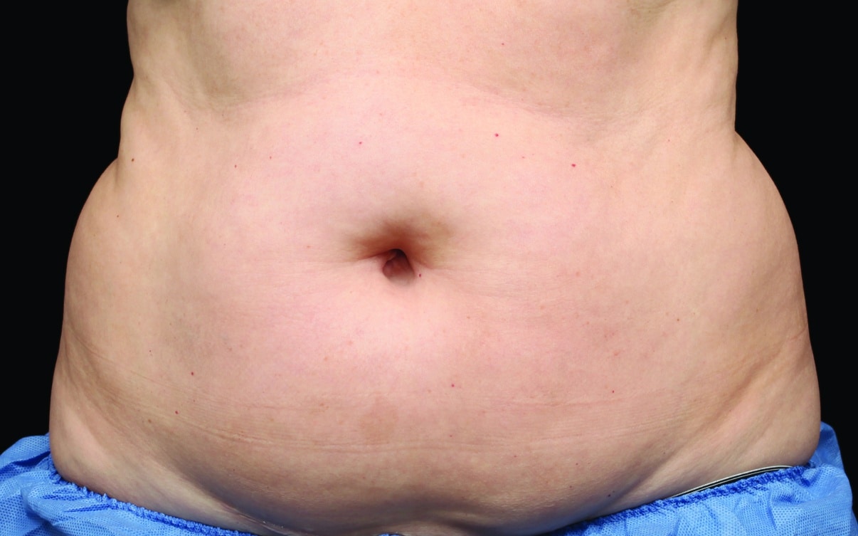 Before CoolSculpting | Azul Cosmetic Surgery and Medical Spa | Naples FL