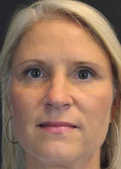 Same woman's smoother face after Instalift | Fort Meyers InstaLift