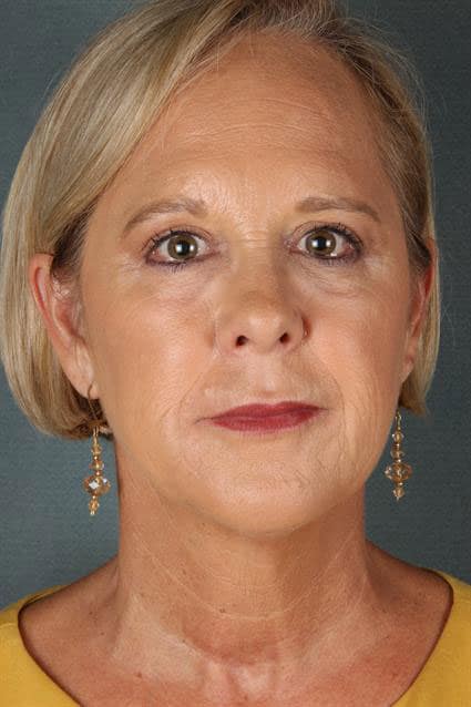 A liquid facelift after image of a woman