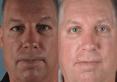 before and after photos just for men azul cosmetic surgery