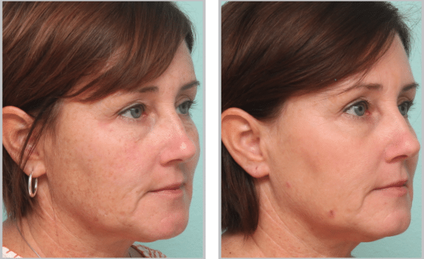 middle aged woman before and after microlaser peel treatment with much smoother skin after procedure
