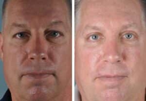 Eyelid surgery before and after on a male patient