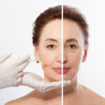Closeup,Woman,Middle,Age,Face,Before,After,Collagen,Face,Injection.