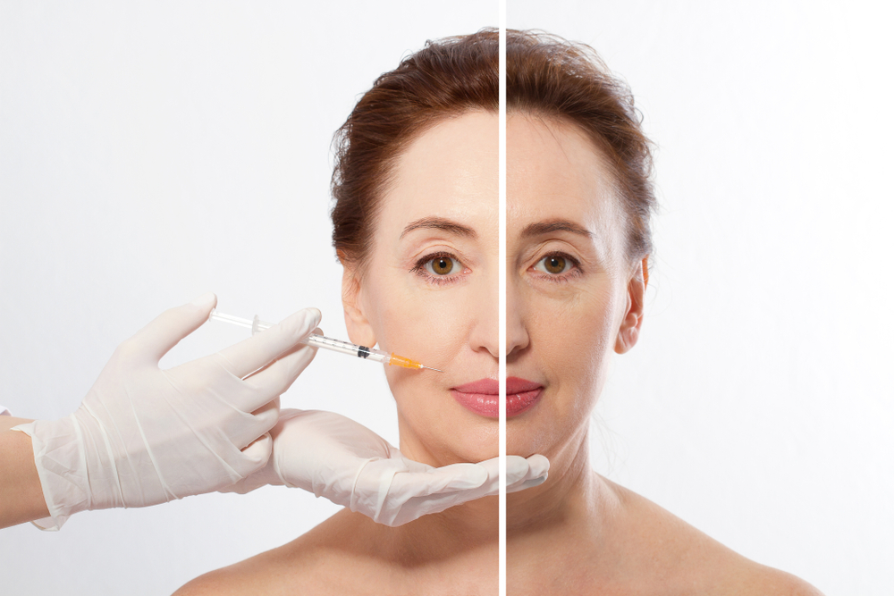Closeup,Woman,Middle,Age,Face,Before,After,Collagen,Face,Injection.
