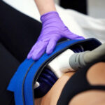 coolsculpting procedure